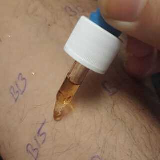 Allerji Testleri