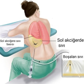 Torasentez (Akciğerden Sıvı Boşaltılması)