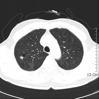 Pulmoner Nodül (Akciğer Nodülü)